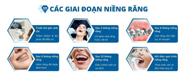 Các giai đoạn niềng răng