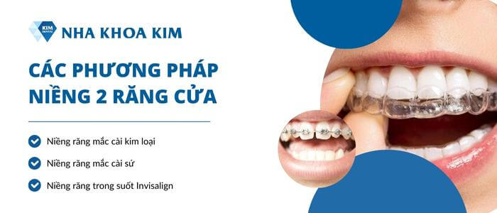 Phương pháp niềng 2 răng cửa