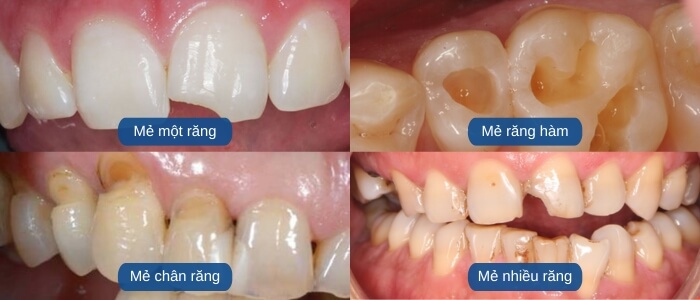 Các trường hợp mẻ răng hay gặp