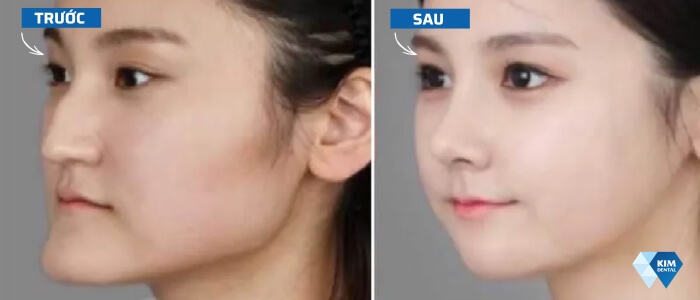 những thay đổi sau khi niềng răng​