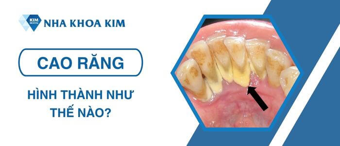 Cao răng hình thành như thế nào?