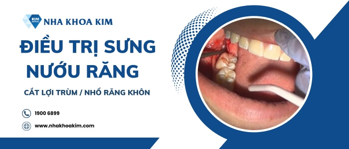 Cắt lợi trùm/nhổ răng khôn trị sưng nướu răng trong cùng hàm dưới