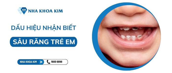 Dấu hiệu sâu răng ở trẻ em là gì?