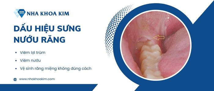 Dấu hiệu sưng nướu trong cùng hàm dưới