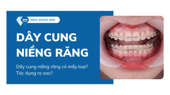 Dây cung niềng răng có mấy loại? Tác dụng ra sao?