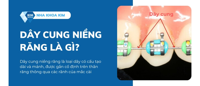 Dây cung niềng răng là gì?