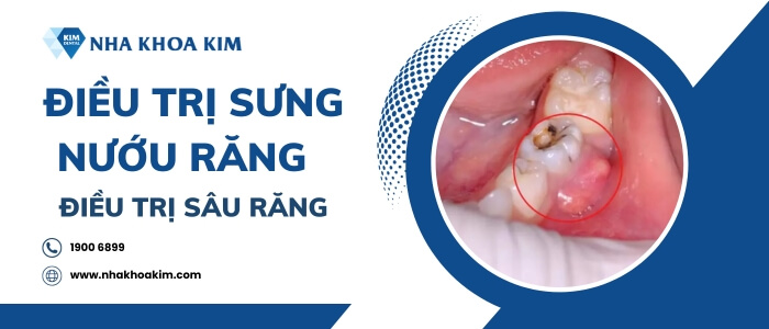 Cách trị sưng nướu răng trong cùng hàm dưới 