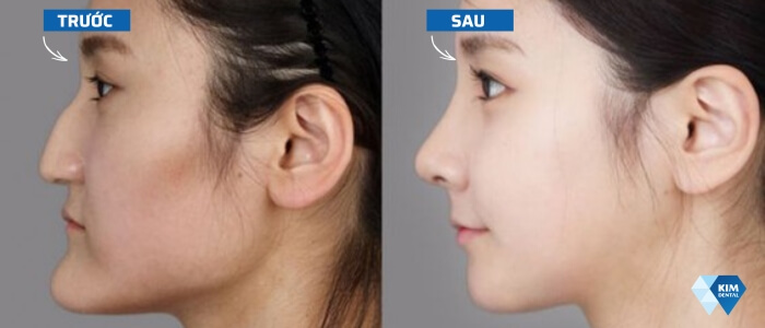 Góc nghiêng trước và sau khi niềng răng