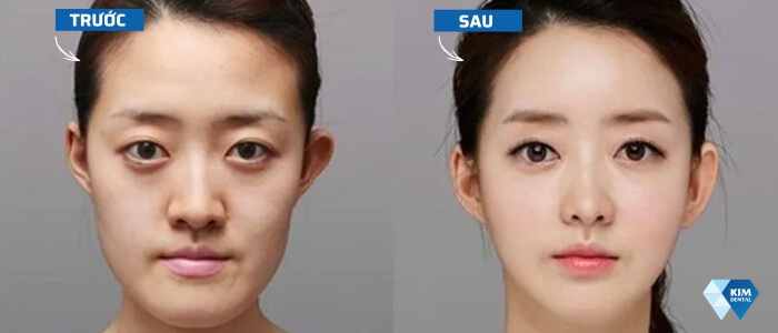 Niềng răng có làm thay đổi khuôn mặt