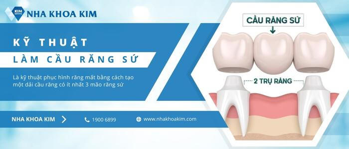 Bắc cầu răng sứ là gì?