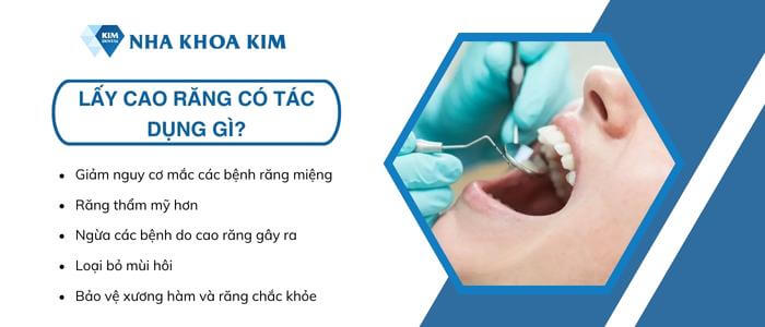 Có nên lấy cao răng không?