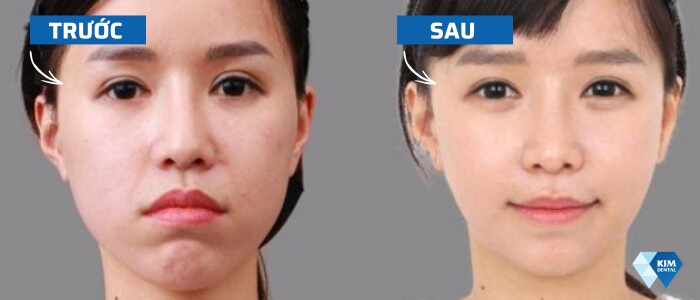 Sự thay đổi của môi trước và sau khi niềng răng