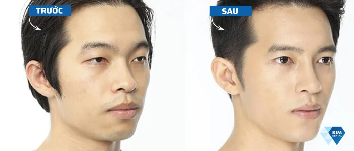 Thay đổi của mũi trước và sau khi niềng răng
