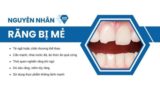 Tại sao răng bị mẻ? Răng mẻ nên trám hay bọc răng sứ?