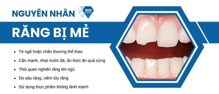 Tại sao răng bị mẻ?