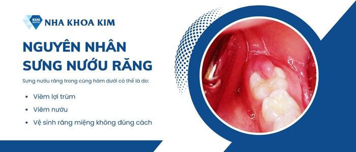 Nguyên nhân gây sưng nướu răng trong cùng hàm dưới