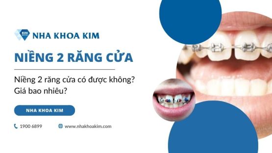 Niềng 2 răng cửa có được không? Giá bao nhiêu?