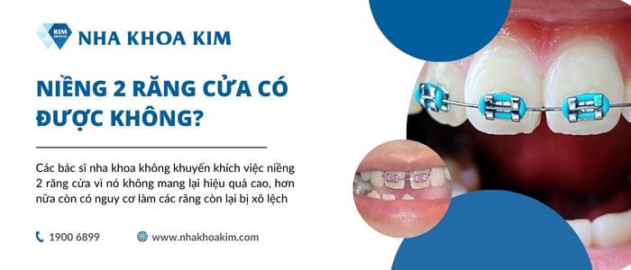 Niềng 2 răng cửa có được không?