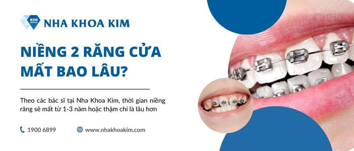 Niềng 2 răng cửa mất bao lâu?
