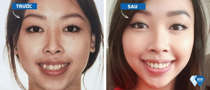 niềng răng làm thay đổi khuôn mặt như thế nào