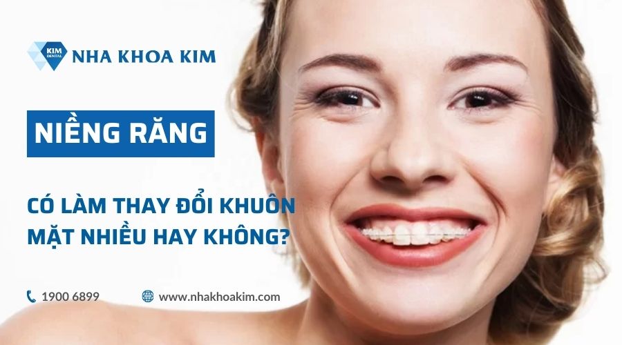 Niềng răng có làm thay đổi khuôn mặt nhiều hay không?