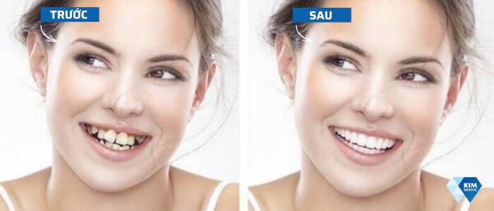 Những thay đổi sau khi niềng răng ở người trưởng thành