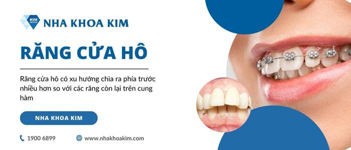 Niềng 2 răng cửa bị hô