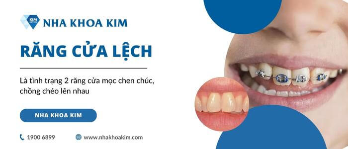 Niềng 2 răng cửa bị lệch