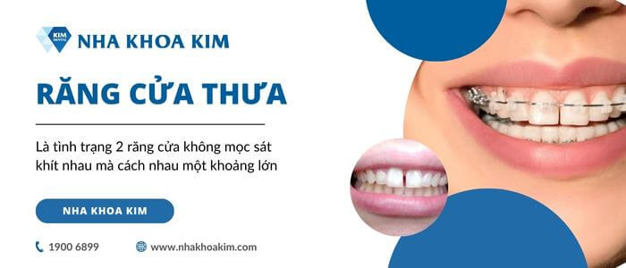 Niềng răng cửa bị thưa