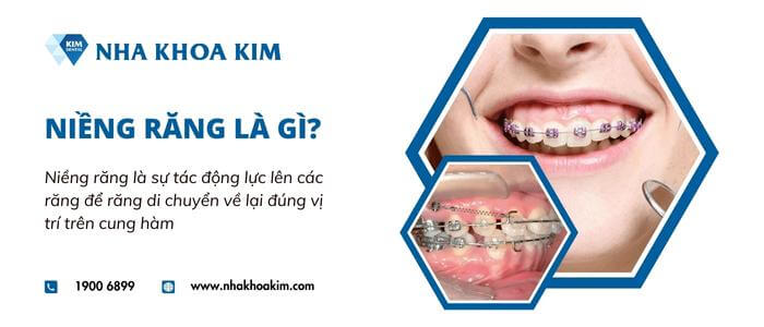 Niềng răng thẩm mỹ là gì?