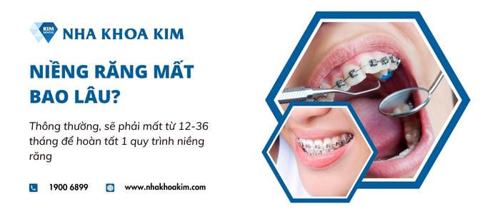 Quá trình niềng răng mất bao lâu?