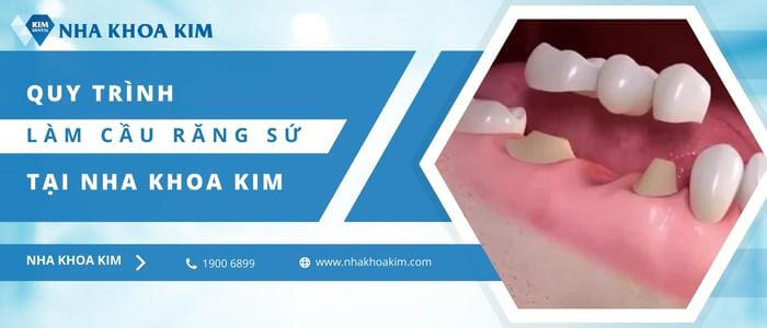 Quy trình bắc cầu răng sứ tại Nha Khoa Kim 