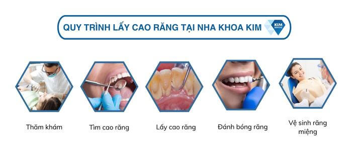 Quy trình lấy cao răng diễn ra như thế nào?