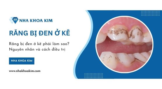 Răng bị đen ở kẽ phải làm sao? Nguyên nhân và cách điều trị