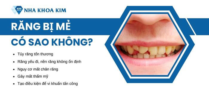 Mẻ răng có sao không?