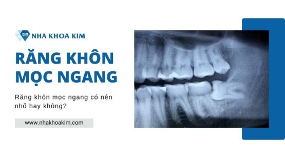 Răng khôn mọc ngang có nên nhổ hay không?