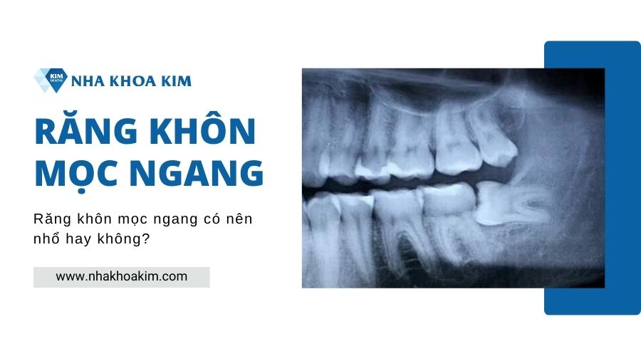 Răng khôn mọc ngang có nên nhổ hay không?