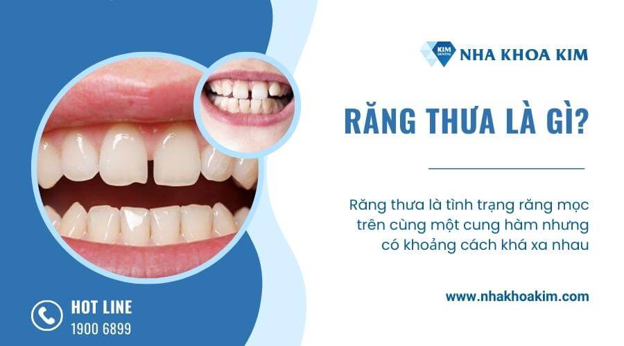 Răng thưa là gì? 