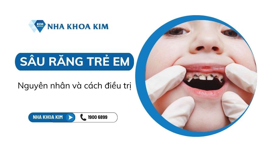 Sâu răng trẻ em là gì? Nguyên nhân và cách điều trị hiệu quả