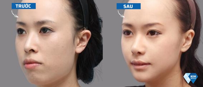 Khuôn mặt trước và sau khi niềng răng hô