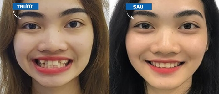 Trước và sau khi niềng răng lệch lạc, khấp khểnh