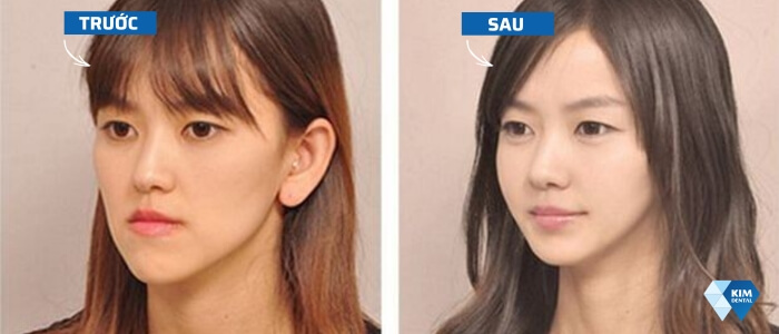 Khuôn mặt trước và sau khi niềng răng móm