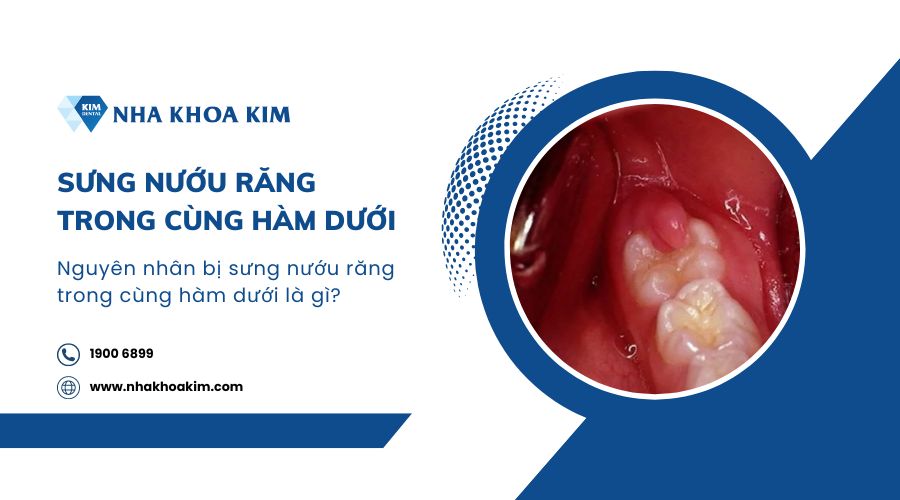 Nguyên nhân và cách trị sưng nướu răng trong cùng hàm dưới