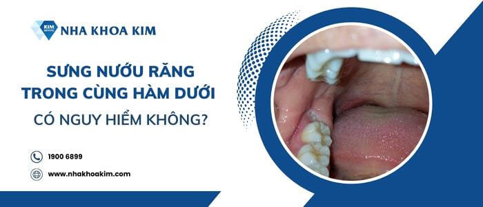 Sưng nướu răng trong cùng hàm dưới có nguy hiểm không?