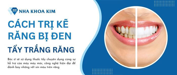 Khắc phục tình trạng răng bị đen ở kẽ bằng cách tẩy trắng răng
