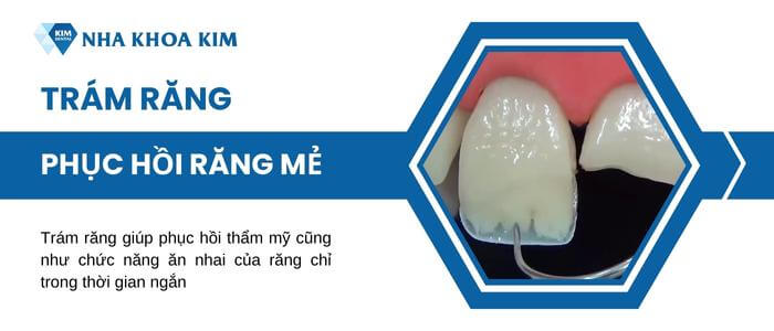 Trám răng bị mẻ