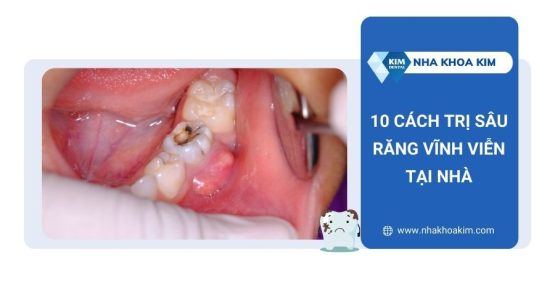10 Cách trị sâu răng vĩnh viễn tại nhà