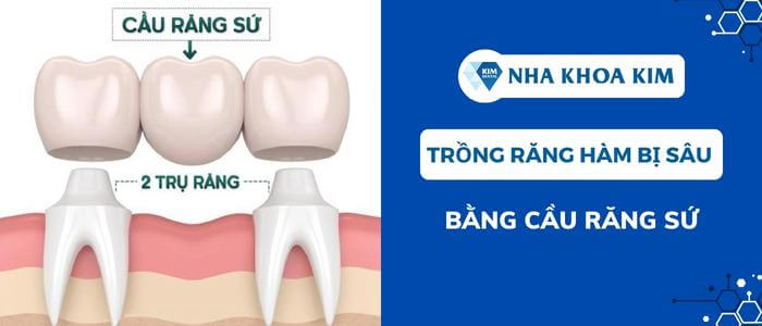 Phương pháp trồng răng hàm bị sâu bằng cầu răng sứ