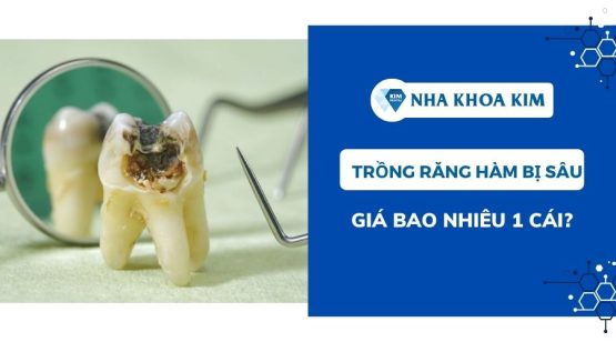 Trồng răng hàm bị sâu giá bao nhiêu 1 cái?