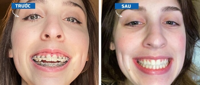 Trước và sau khi niềng răng điều trị khớp cắn hở